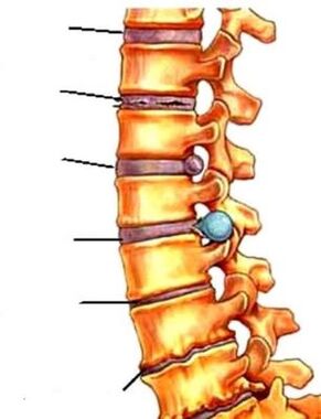 osteocondrita coloanei vertebrale