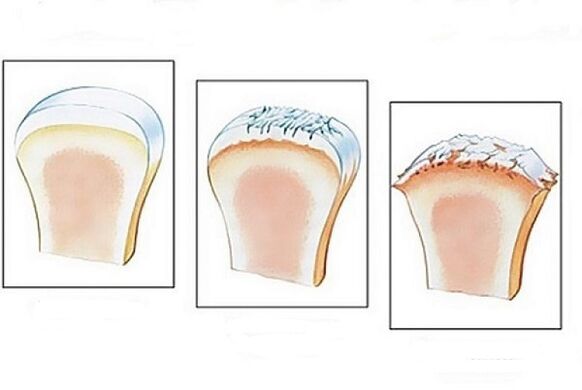 afectarea articulațiilor în diferite stadii ale dezvoltării artrozei