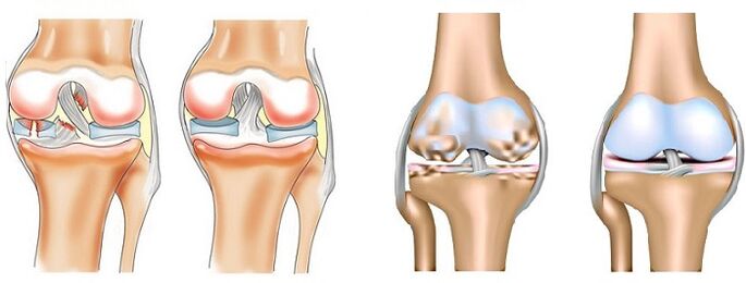 Diferența dintre artrită (stânga) și artroza (dreapta) a articulațiilor