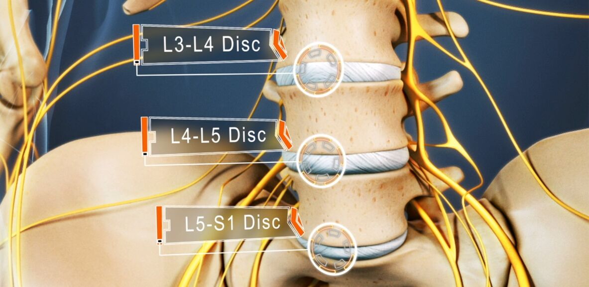 Discurile coloanei vertebrale lombare, care sunt cel mai adesea afectate în osteocondroză