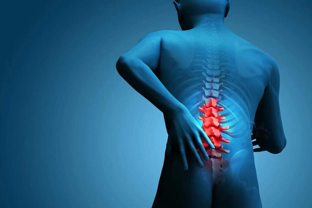 Principalul simptom al osteocondrozei coloanei lombare este durerea de spate. 