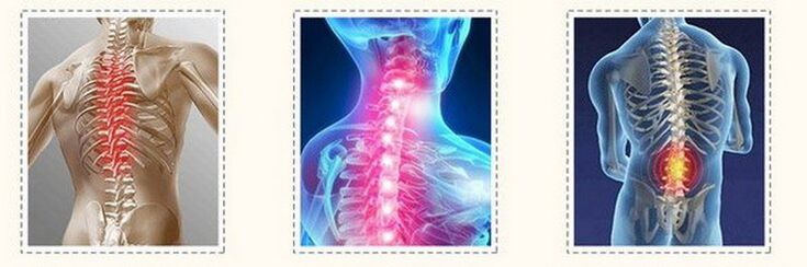 osteochondroza diferită a coloanei vertebrale