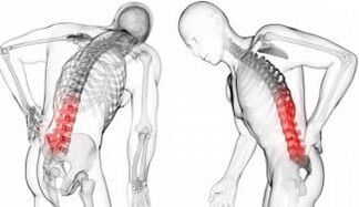 Hernie intervertebrală - Complicație cu osteochondroză