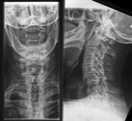 Cervical X -RAY - Metoda de diagnosticare a osteochondrozei