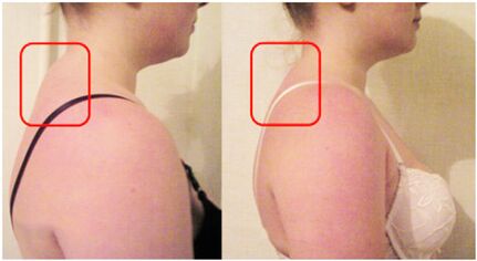 Formarea rolei musculare cu osteochondroză cervicală