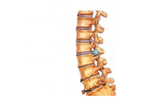 Deteriorarea coloanei vertebrale cu osteocondroză cervicală