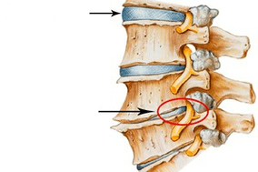Disc coloanei vertebrale normale și deteriorate cu osteochondroză cervicală