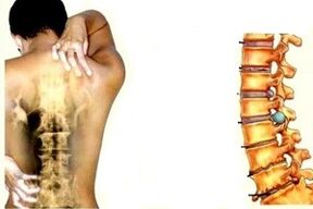 Dureri de spate în diferite etape ale dezvoltării osteocondrozei cervicale