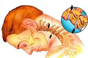 ciupirea nervului în coloana vertebrală cu osteocondroză cervicală