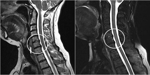 RMN-ul coloanei cervicale
