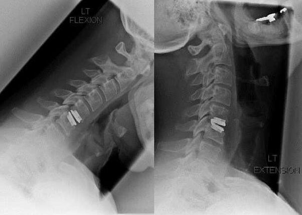 imaginea coloanei vertebrale după operație
