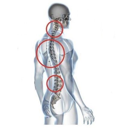 locurile de osteocondroză spinală