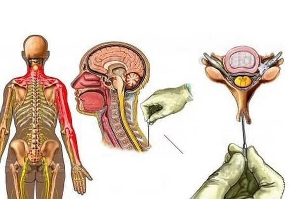 tratamentul osteocondrozei cervicale cu acupunctură