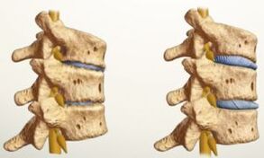 cum arata osteocondroza