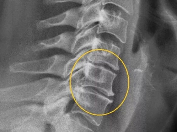 Osteocondroza coloanei cervicale pe radiografie